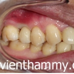 Cấy ghép răng implant 7