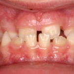 Vẩu xương hàm dưới và cách điều trị