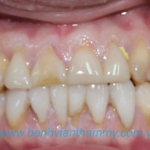 Răng sứ Emax Zircad - Ivoclar Vivadent 7