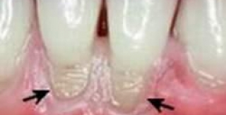 Phòng và điều trị mòn răng