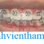 Chỉnh hình răng thẩm mỹ điều trị răng chen chúc với mắc cài kim loại