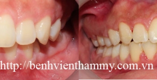 Chỉnh hình răng thẩm mỹ điều trị răng dư kẽ giữa với mắc cài kim loại