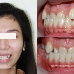 Điều trị răng móm – chen chúc - cắn chéo