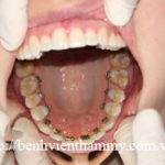 Chỉnh hình răng thẩm mỹ điều trị với mắc cài mặt lưỡi