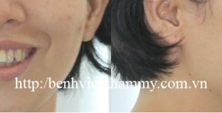 Chỉnh hình răng thẩm mỹ điều trị răng hô – cắn hở với mắc cài kim loại