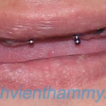 Implant cố định toàn hàm