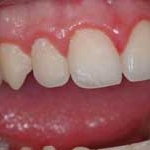 Mảng bám vi khuẩn gây bệnh nha chu là gì?