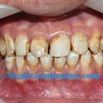 Răng sứ Emax Zircad - Ivoclar Vivadent 11