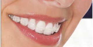 Cười lộ nướu, nguyên nhân và cách khắc phục.