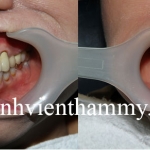 Răng nhiễm tertracyclin 02