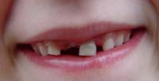 Một số lưu ý khi trẻ thay răng