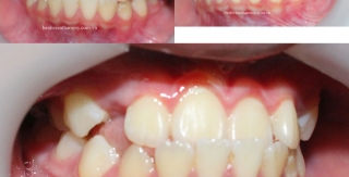 Chỉnh hình răng mặt can thiệp sớm - răng móm