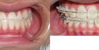 Chỉnh hình răng thẩm mỹ điều trị răng móm với mắc cài sứ thẩm mỹ