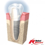 HỆ THỐNG IMPLANT NOBEL BIOCARE TẠI AVA