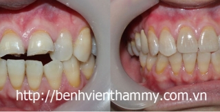 Răng sứ Emax Zircad - Ivoclar Vivadent - Thụy Sỹ 25