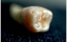 Răng sâu tự liền