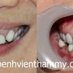 Răng sứ Emax Zircad - Ivoclar Vivadent - Thụy Sỹ 23