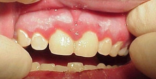 Viêm nướu do virus herpes