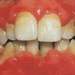 QUÁ TRIỂN NƯỚU DO PHENYTOIN