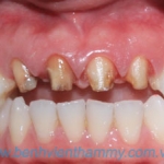 Răng sứ Emax Zircad - Ivoclar Vivadent 9