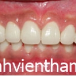 Răng sứ Emax Zircad - Ivoclar Vivadent - Thụy Sỹ 22