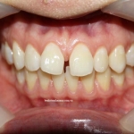 Niềng răng thưa thẩm mỹ