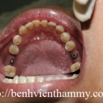 Cấy ghép implant 1