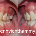 Răng sứ Emax Zircad - Ivoclar Vivadent - Thụy Sỹ 21