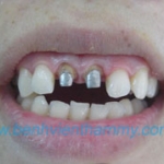 Răng toàn sứ Emax ZirCad