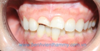 Răng sứ Emax Zircad - Ivoclar Vivadent