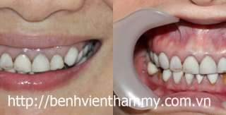 Răng sứ Emax Zircad - Ivoclar Vivadent - Thụy Sỹ 23