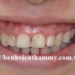 Răng sứ Emax Zircad - Ivoclar Vivadent 12