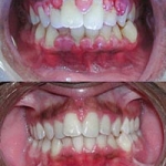 ĐIỀU TRỊ DỨT ĐIỂM BỆNH VIÊM NƯỚU VÀ VÔI RĂNG