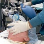 CÓ CẦN GÂY MÊ KHI ĐẶT IMPLANT ?