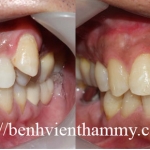 Cấy ghép răng implant 4