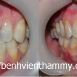 Răng sứ Emax Zircad - Ivoclar Vivadent - Thụy Sỹ 25