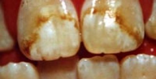 Đôi điều về fluor trong sức khỏe răng miệng