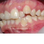 Chỉnh hình răng - niềng răng thẩm mỹ 01