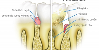 Điều trị nha chu, viêm nướu êm ái với Airflow Thụy Sĩ