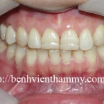 Răng sứ Emax Zircad - Ivoclar vivadent 13