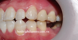 Răng sứ đẹp tự nhiên