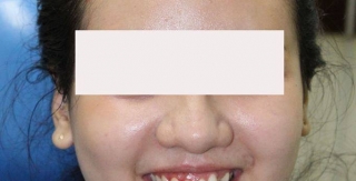 Cải thiện nụ cười với niềng răng.........! 01