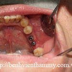 Cấy ghép implant 2