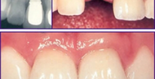 Biện pháp vệ sinh răng miệng cho bệnh nhân mang implant