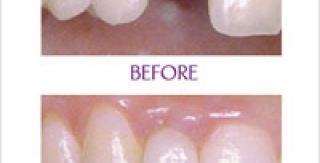 THỰC HIỆN PHỤC HÌNH TRỰC TIẾP TRÊN IMPLANT