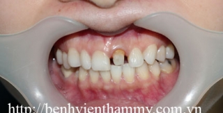 Răng sứ Emax Zircad - Ivoclar Vivadent - Thụy Sỹ 18