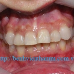 Răng sứ Emax Zircad - Ivoclar Vivadent 10