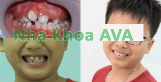 Bảng giá niềng răng mới nhất tại nha khoa AVA