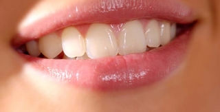 ĐIỀU TRỊ CƯỜI HỞ NƯỚU KẾT HỢP RĂNG SỨ THẨM MỸ