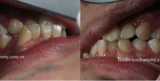 Chỉnh hình răng thẩm mỹ điều trị răng móm – chen chúc - cắn chéo